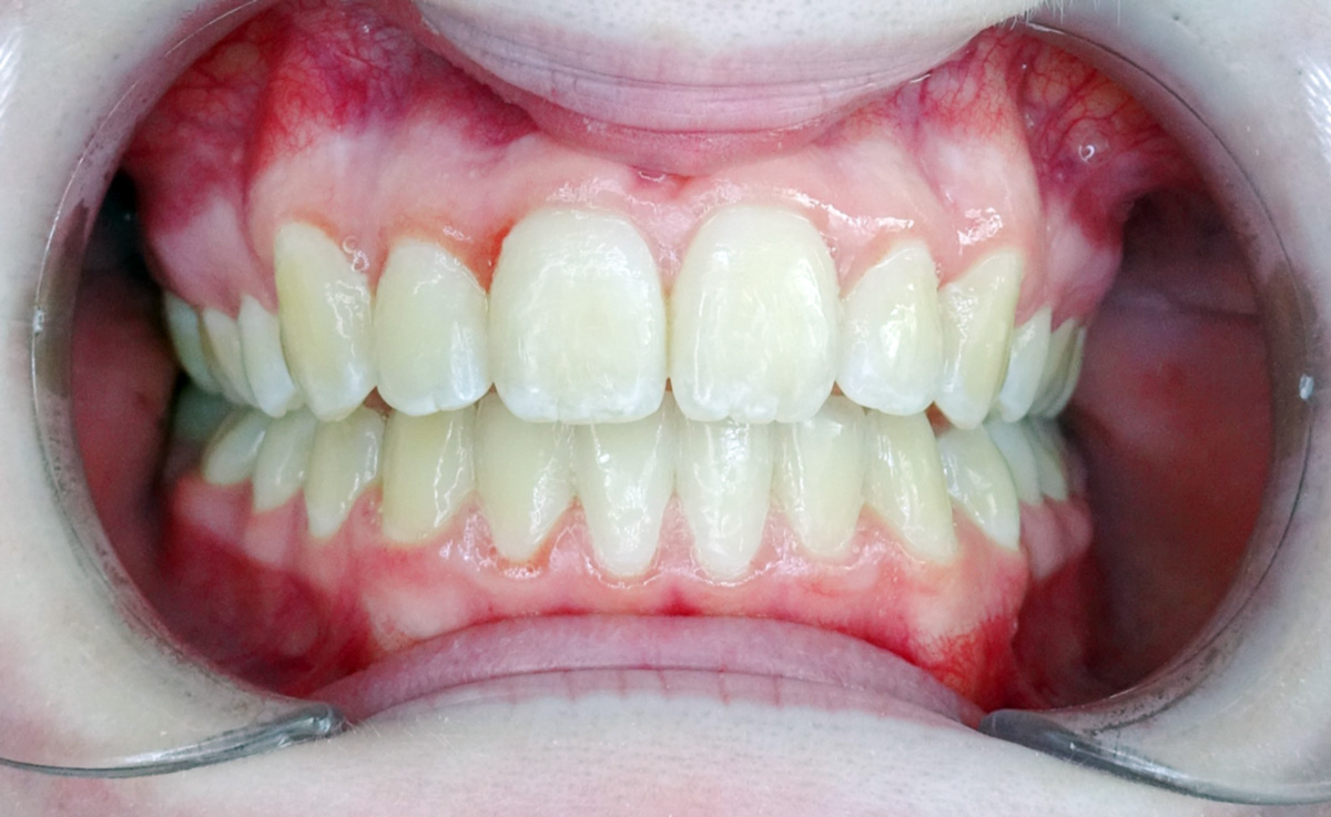 Katelyn After Orthodontic Treatment