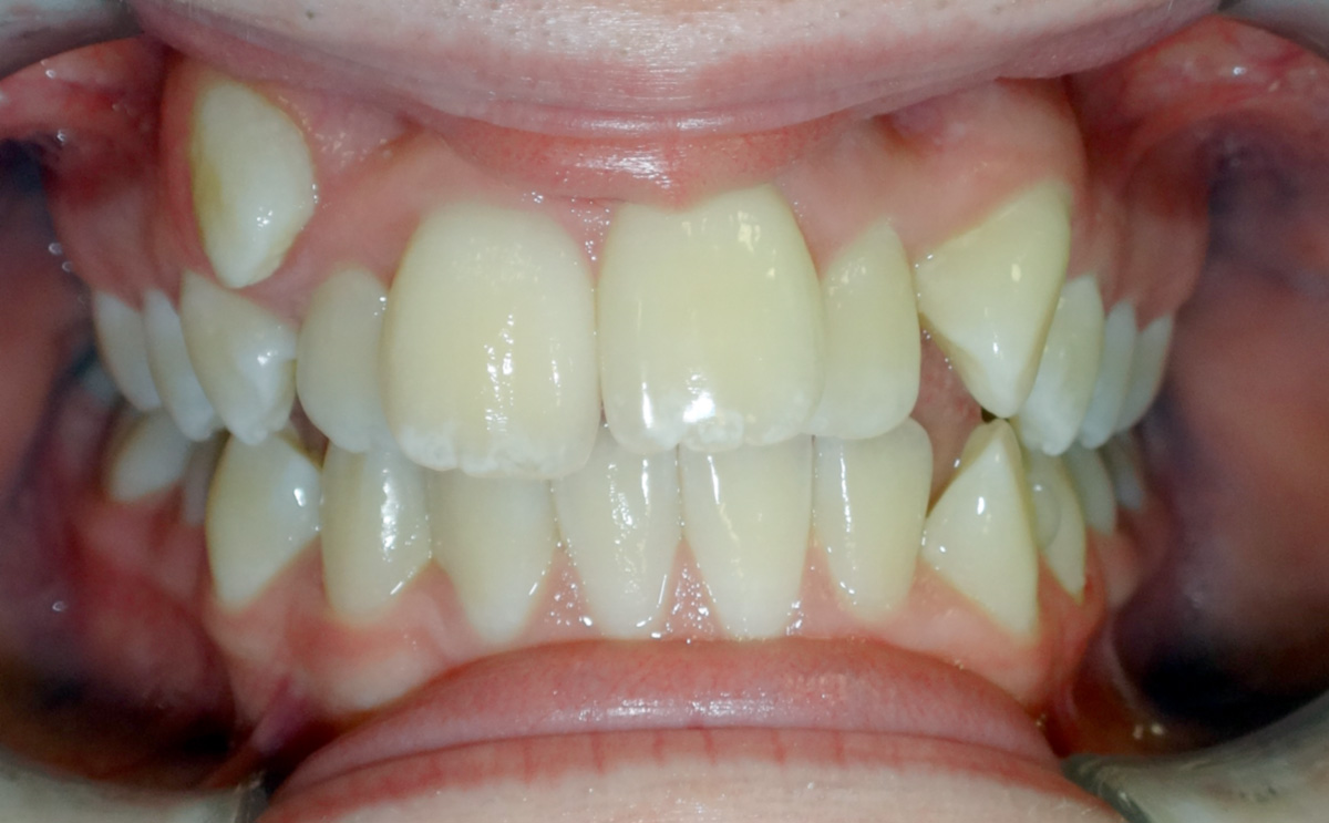 Katelyn Before Orthodontic Treatment